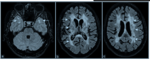 NOTCH3 Variants in Patients with Suspected CADASIL