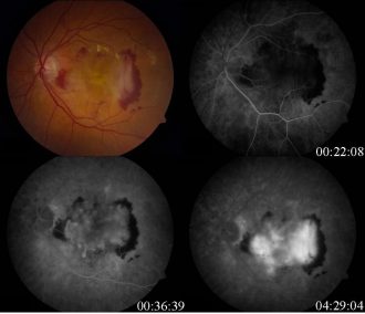 assessment of prevalence of Type 1 CFI rare variants