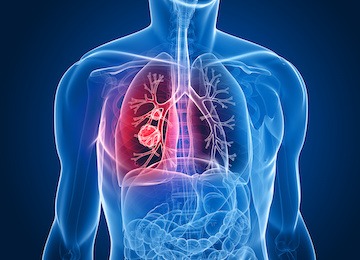 tumor mutational burden TMB analysis via NGS targeted amplicon sequencing