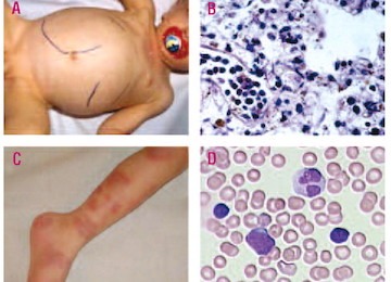 jmml juvenile myelomonocytic leukemia