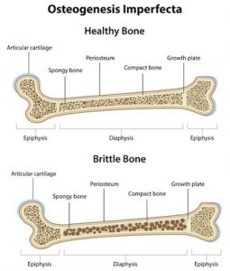Icon_Osteogenesis Imperfecta_360x423