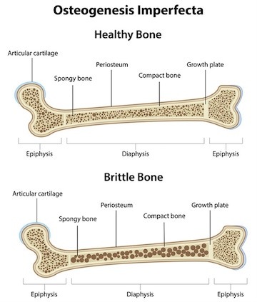 Icon_Osteogenesis Imperfecta_360x423
