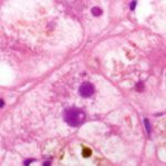The role of genetic mutations in intrahepatic cholestasis of pregnancy The role of genetic mutations in intrahepatic cholestasis of pregnancy