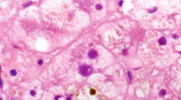The role of genetic mutations in intrahepatic cholestasis of pregnancy The role of genetic mutations in intrahepatic cholestasis of pregnancy