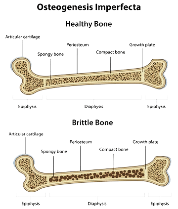 Osteogenesis Imperfecta